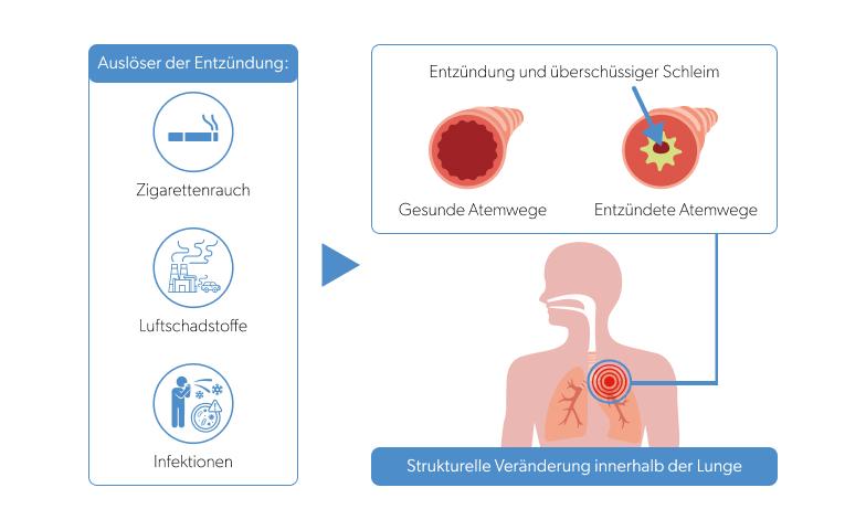 Grafik 1: Was bewirkt eine Typ-2-Entzündung in der Lunge?